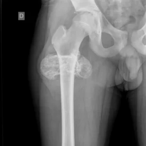 RX FEMUR PROYECCIONES