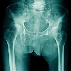 RX PELVIS