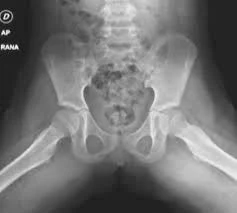 RX PELVIS BEBES