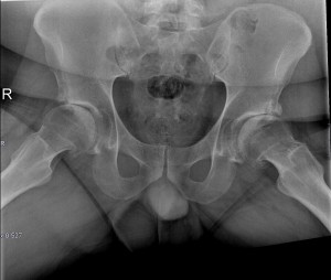 RX PELVIS RANA