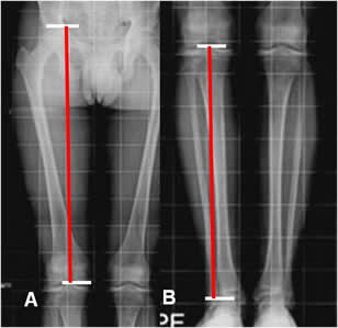 RX RADIOMETRIA DE MIEMBROS INFERIORES